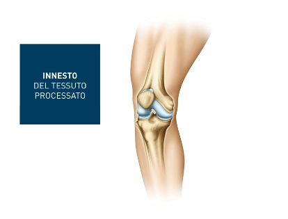 injection of processed tissue, lipogems procedure